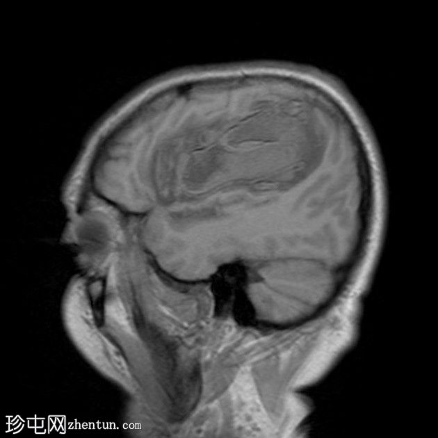 颅内霉菌性动脉瘤破裂