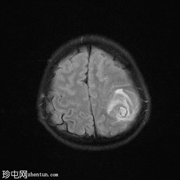 颅内霉菌性动脉瘤破裂