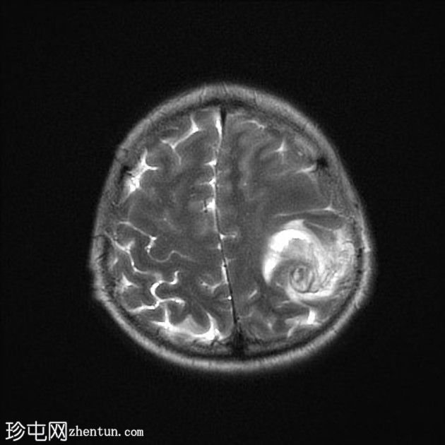 颅内霉菌性动脉瘤破裂