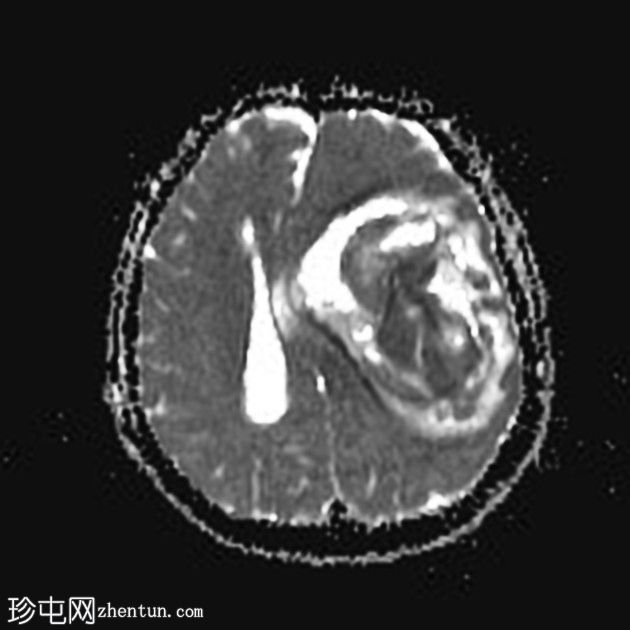 颅内霉菌性动脉瘤破裂