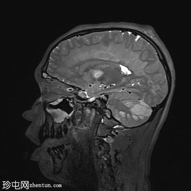 海洛因引起脑白质病