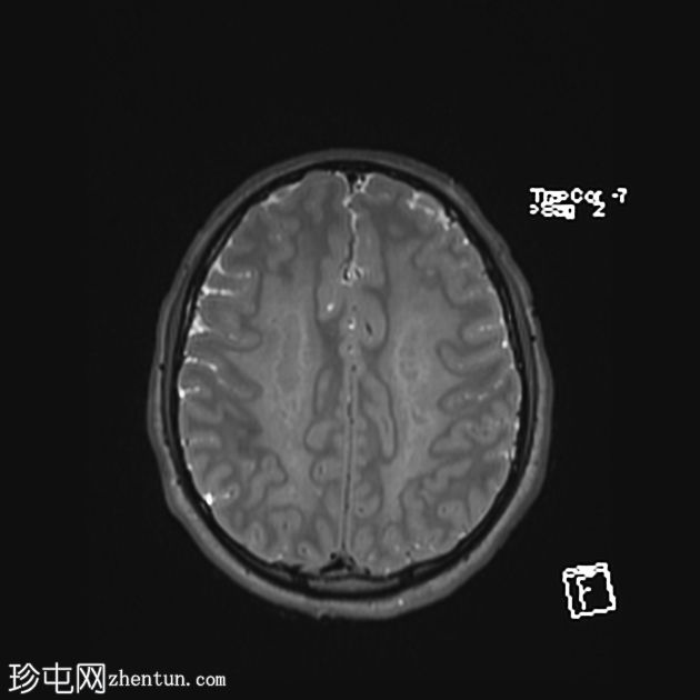 海洛因引起脑白质病