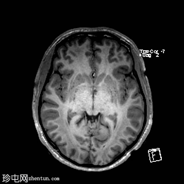 海洛因引起脑白质病