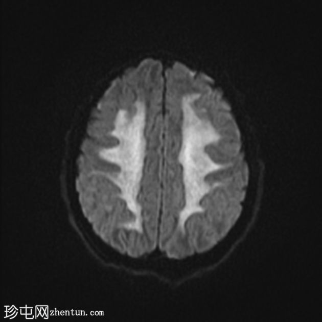 海洛因引起脑白质病