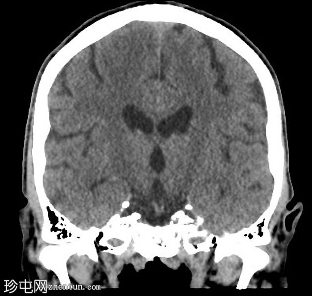 肺和中枢神经系统隐球菌病