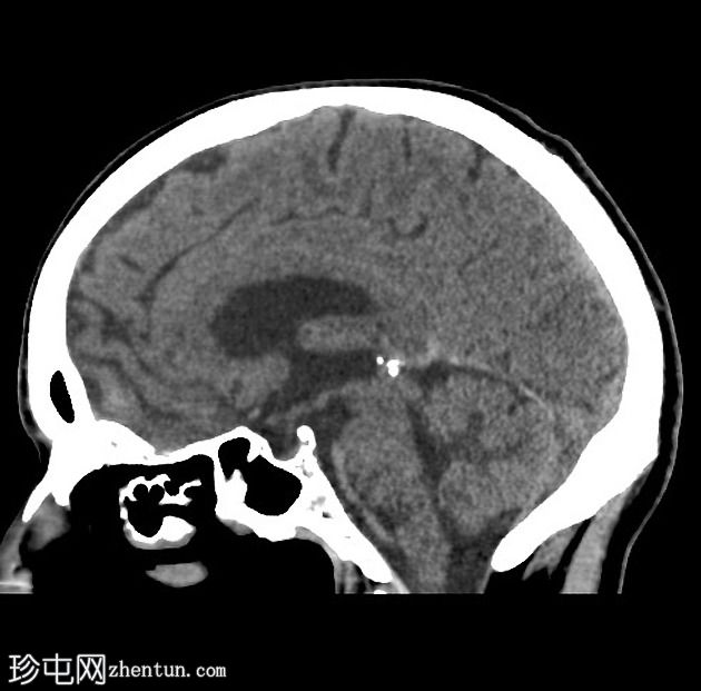 肺和中枢神经系统隐球菌病