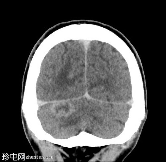 肺和中枢神经系统隐球菌病