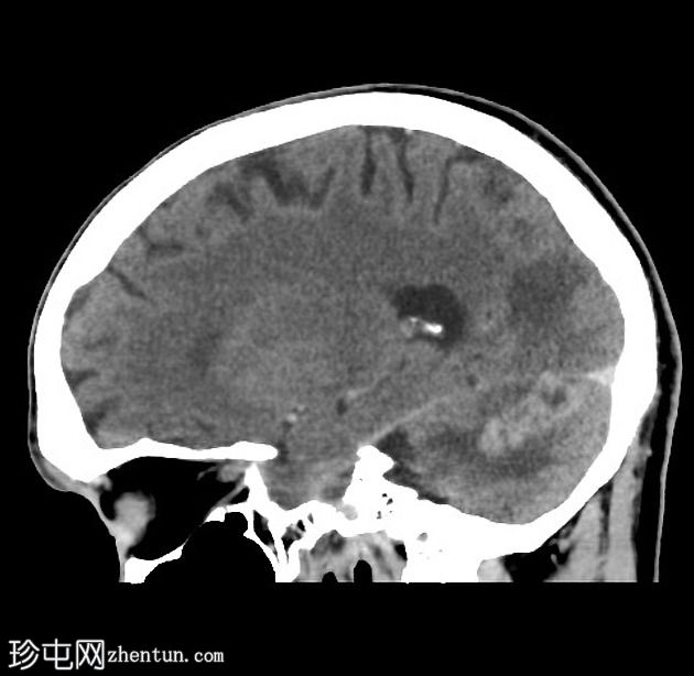 肺和中枢神经系统隐球菌病