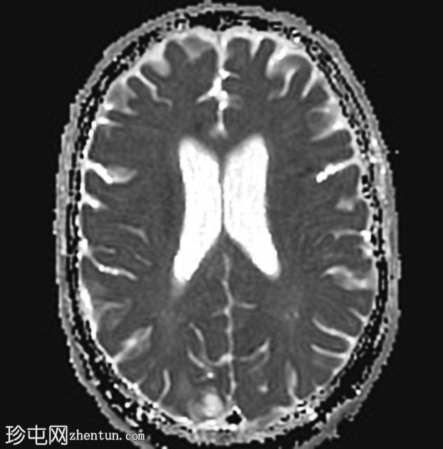 肺和中枢神经系统隐球菌病