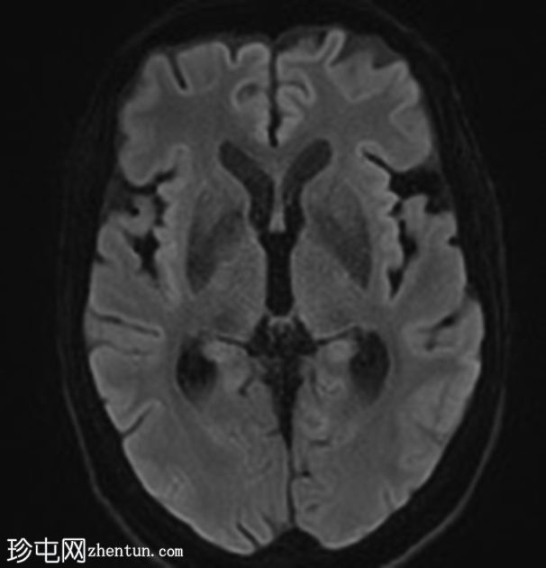 肺和中枢神经系统隐球菌病