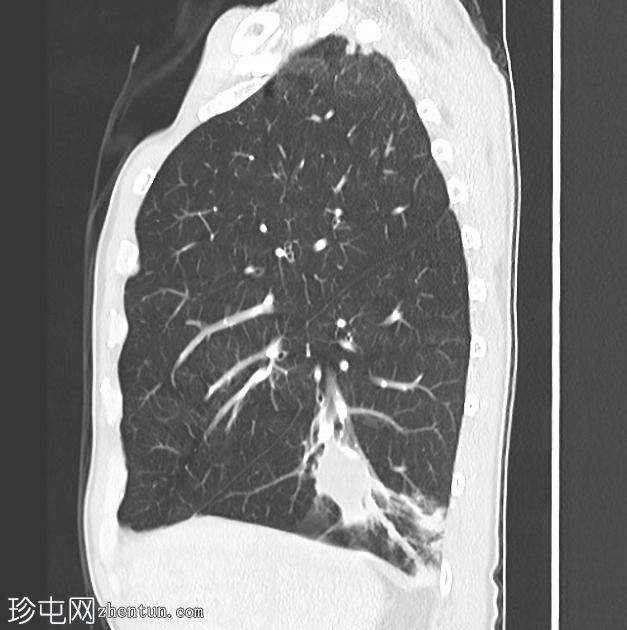 肺和中枢神经系统隐球菌病