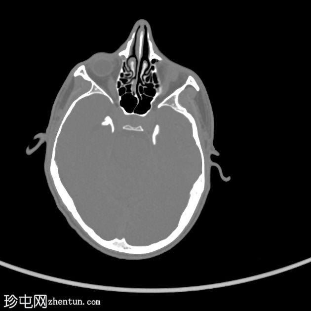 类脂蛋白沉积症