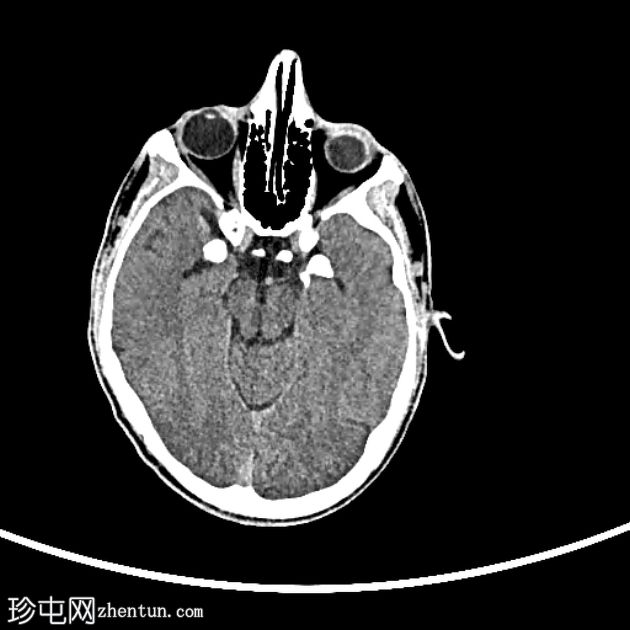 类脂蛋白沉积症