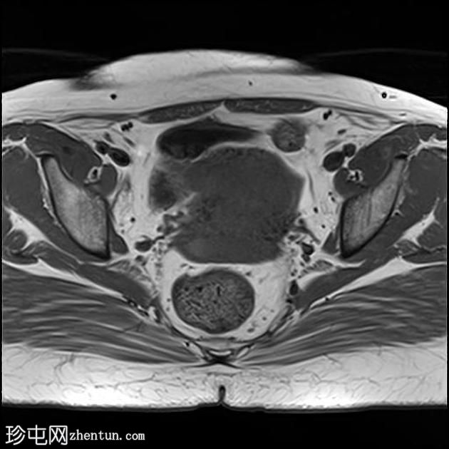 弥漫性子宫子宫腺肌症伴卵巢和腹膜下子宫内膜异位症