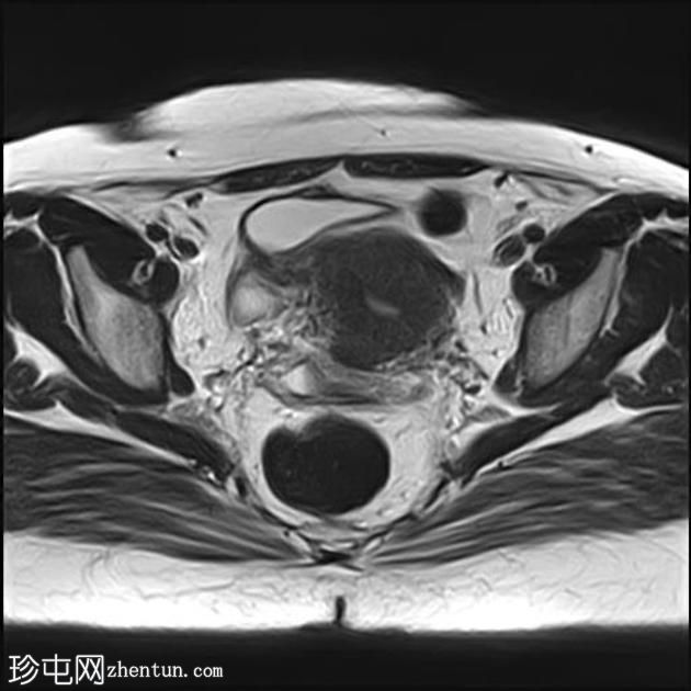 弥漫性子宫子宫腺肌症伴卵巢和腹膜下子宫内膜异位症