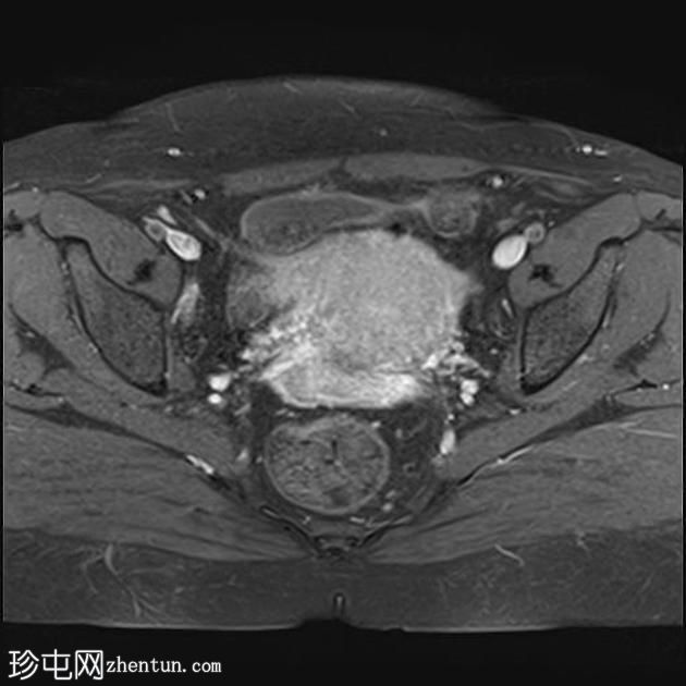 弥漫性子宫子宫腺肌症伴卵巢和腹膜下子宫内膜异位症