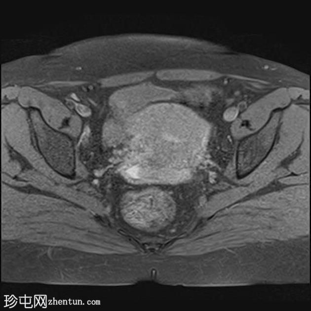 弥漫性子宫子宫腺肌症伴卵巢和腹膜下子宫内膜异位症