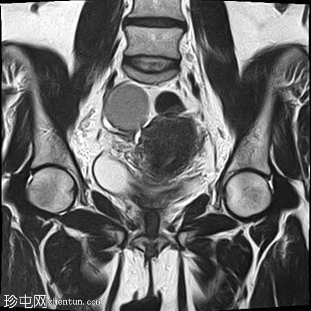 弥漫性子宫子宫腺肌症伴卵巢和腹膜下子宫内膜异位症