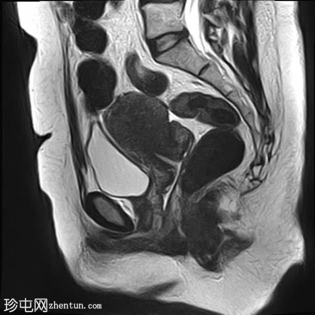 弥漫性子宫子宫腺肌症伴卵巢和腹膜下子宫内膜异位症