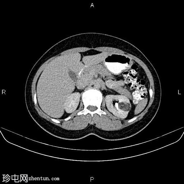 肾血管平滑肌脂肪瘤