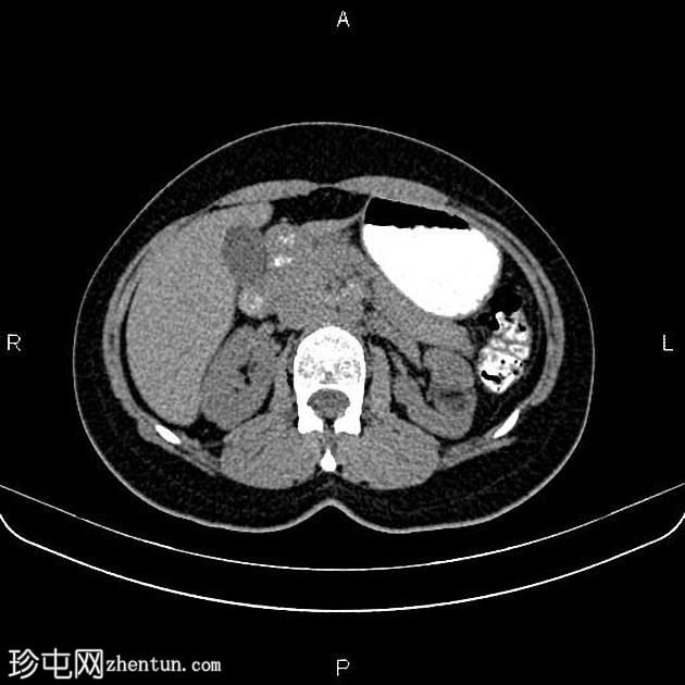 肾血管平滑肌脂肪瘤