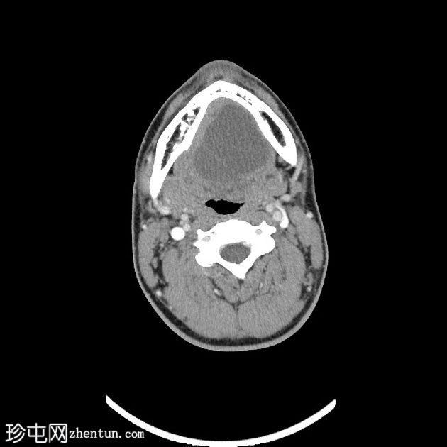 颈部支气管囊肿