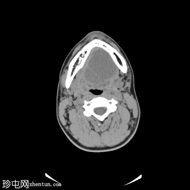 颈部支气管囊肿