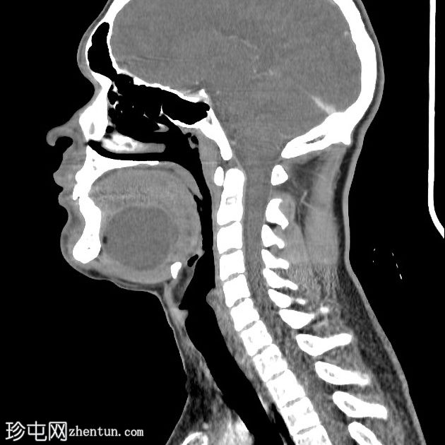 颈部支气管囊肿