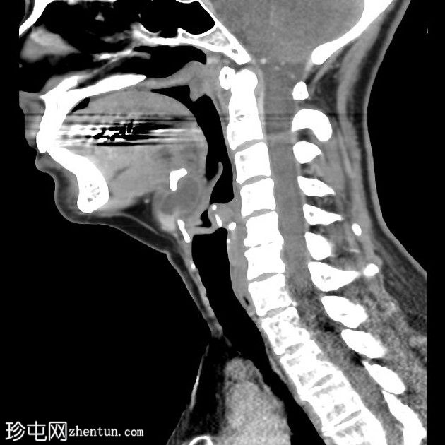 甲状舌管囊肿伴会厌前腔扩张