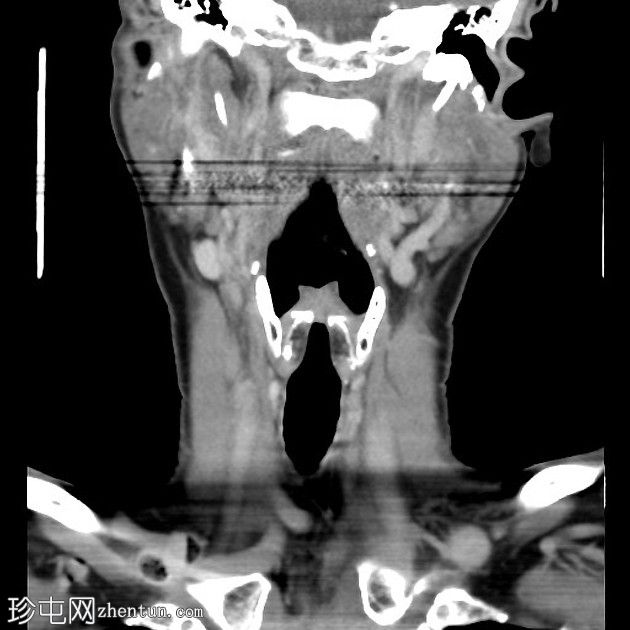 甲状舌管囊肿伴会厌前腔扩张