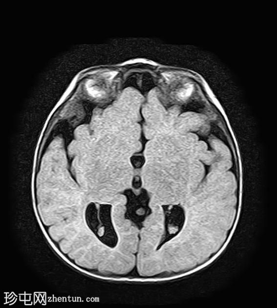 胼胝体发育不全伴半球间囊肿和室管膜下异位