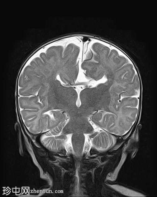 胼胝体发育不全伴半球间囊肿和室管膜下异位