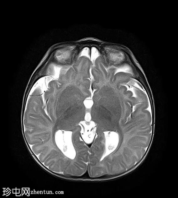 胼胝体发育不全伴半球间囊肿和室管膜下异位