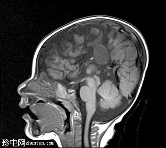 胼胝体发育不全伴半球间囊肿和室管膜下异位