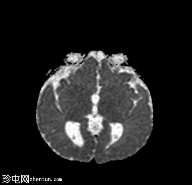 胼胝体发育不全伴半球间囊肿和室管膜下异位