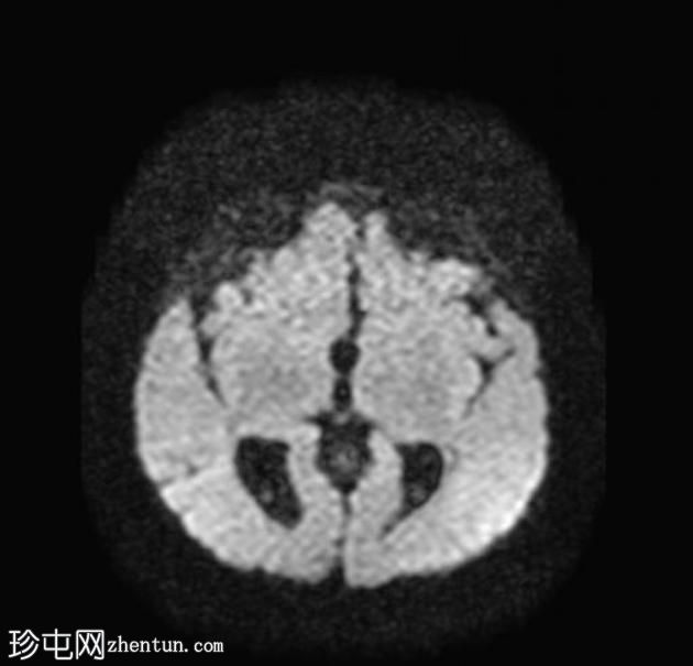 胼胝体发育不全伴半球间囊肿和室管膜下异位