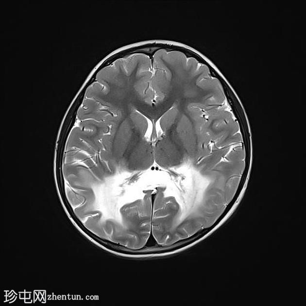 X-连锁肾上腺脑白质营养不良