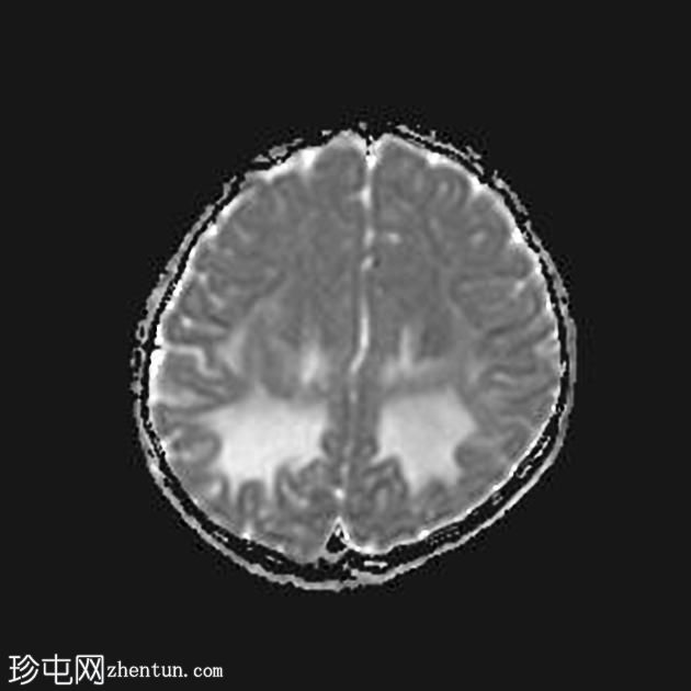 X-连锁肾上腺脑白质营养不良