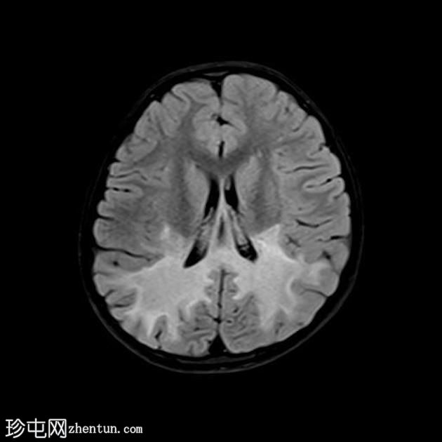 X-连锁肾上腺脑白质营养不良