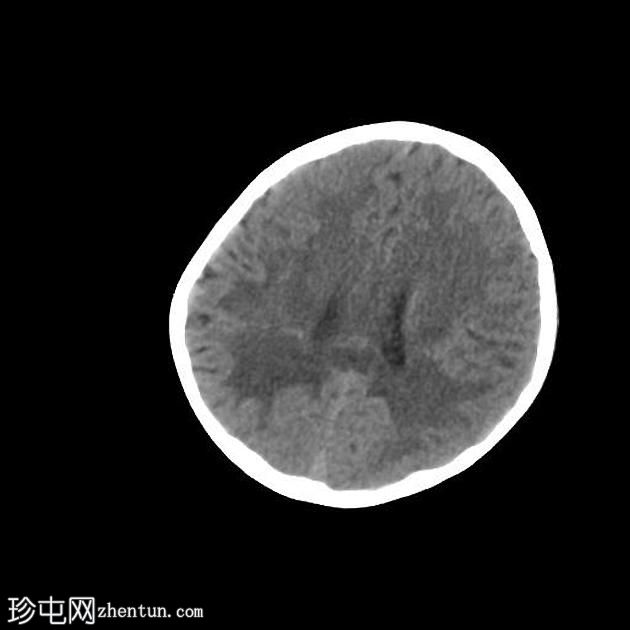 X-连锁肾上腺脑白质营养不良