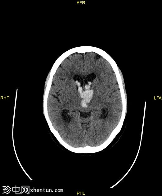 丘脑出血伴脑室扩张和阻塞性脑积水