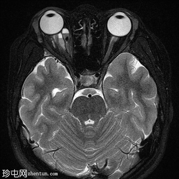 眼眶淋巴管瘤