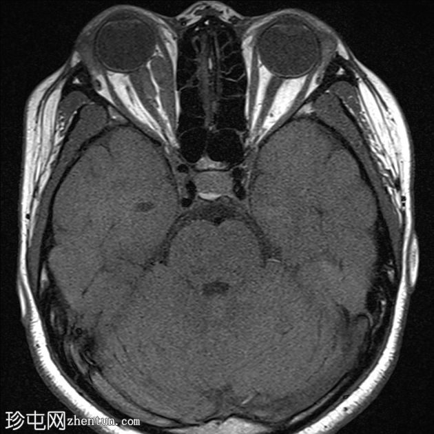 眼眶淋巴管瘤