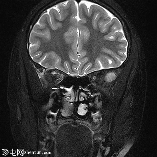 眼眶淋巴管瘤