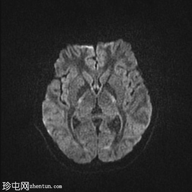 眼眶淋巴管瘤