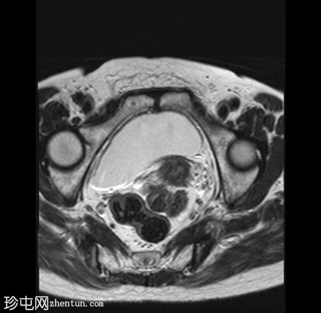 带蒂动脉征的子宫内膜息肉(MRI)