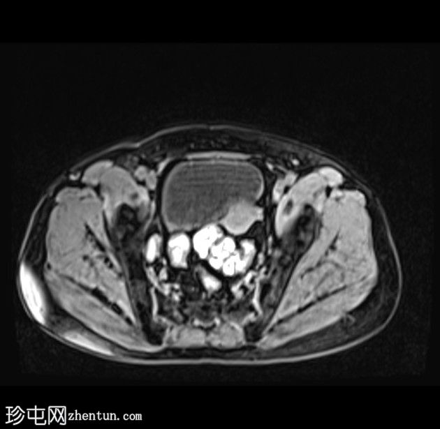 带蒂动脉征的子宫内膜息肉(MRI)