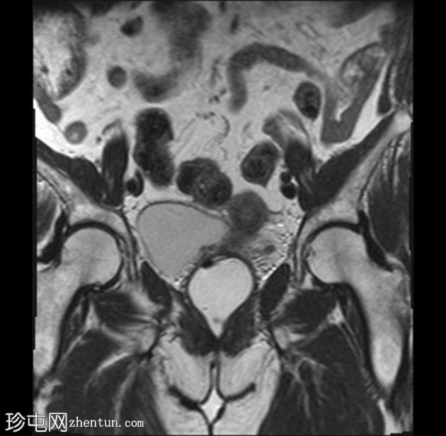 带蒂动脉征的子宫内膜息肉(MRI)