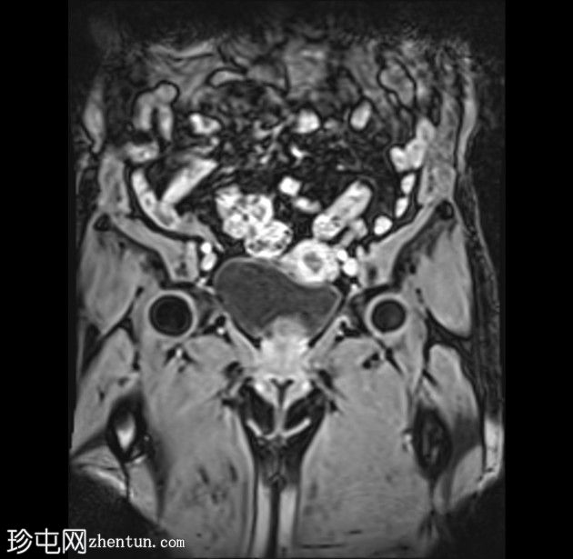 带蒂动脉征的子宫内膜息肉(MRI)