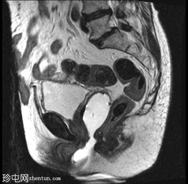 带蒂动脉征的子宫内膜息肉(MRI)